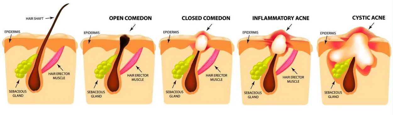 acne diagram